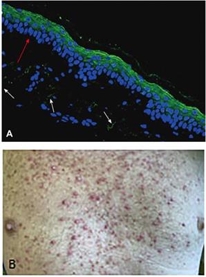 On-Target Side Effects of Targeted Therapeutics of Cancer